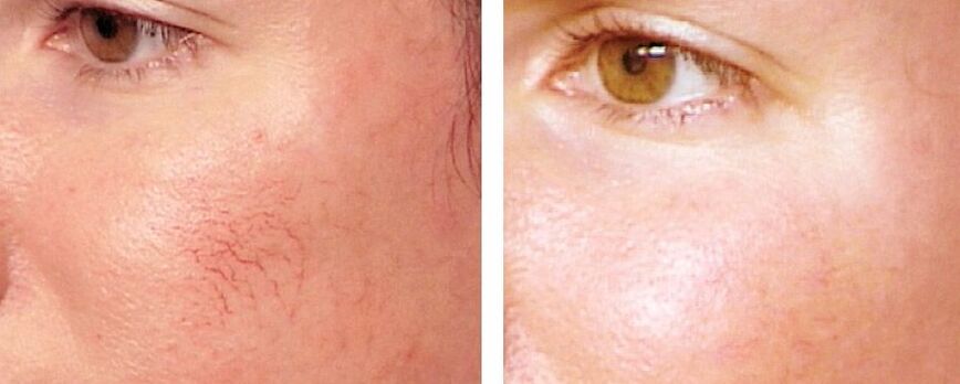 Deireadh a chur le rosacea