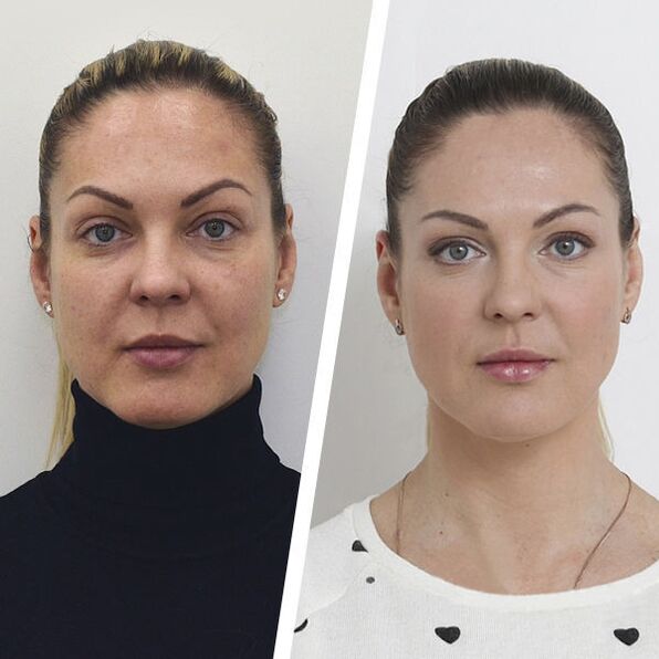 Roimh agus tar éis athnuachan craiceann facial gan máinliacht